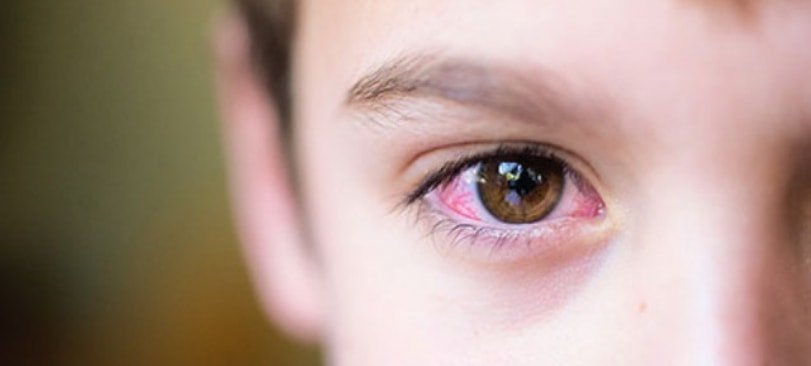 Biểu hiện của đau mắt đỏ