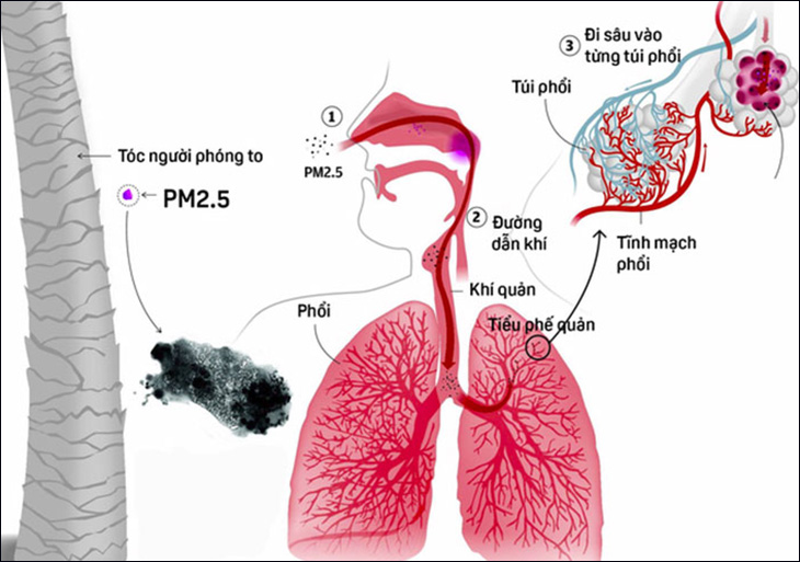 Bụi PM2.5 xâm nhập vào cơ thể làm ảnh hưởng lớn đến phổi