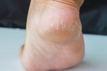 Vùng da gót chân dễ bị khô và nứt nẻ nếu không thường xuyên được chăm sóc