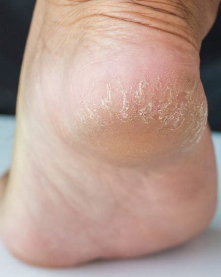 Vùng da gót chân dễ bị khô và nứt nẻ nếu không thường xuyên được chăm sóc