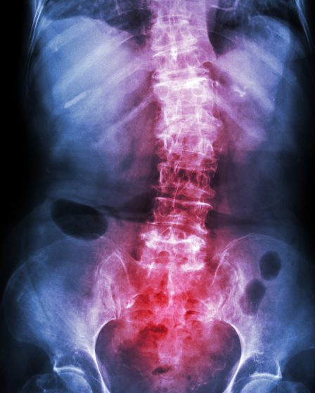 Đau lưng kiểu viêm là triệu chứng đặc trưng của viêm cột sống dính khớp. Ảnh: Shutterstock