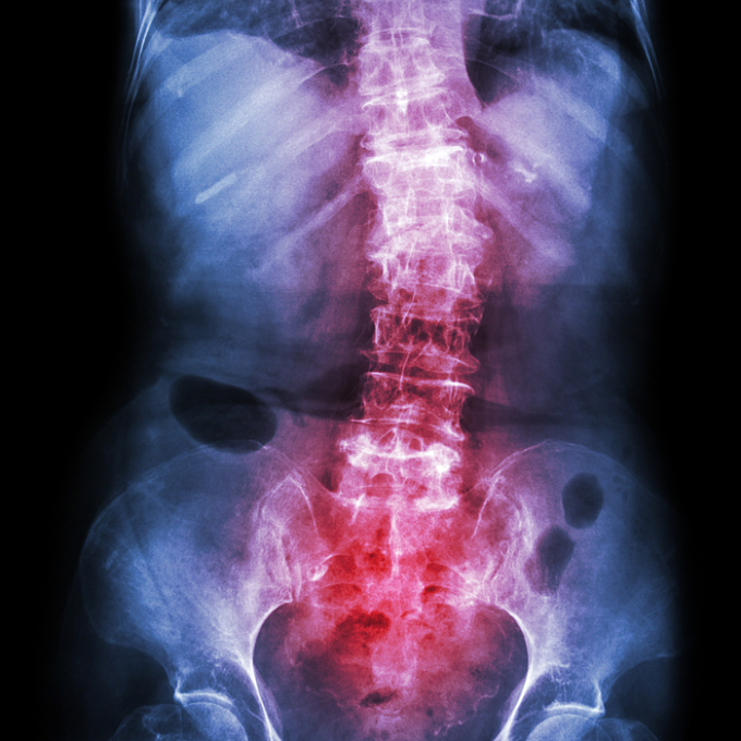 Đau lưng kiểu viêm là triệu chứng đặc trưng của viêm cột sống dính khớp. Ảnh: Shutterstock