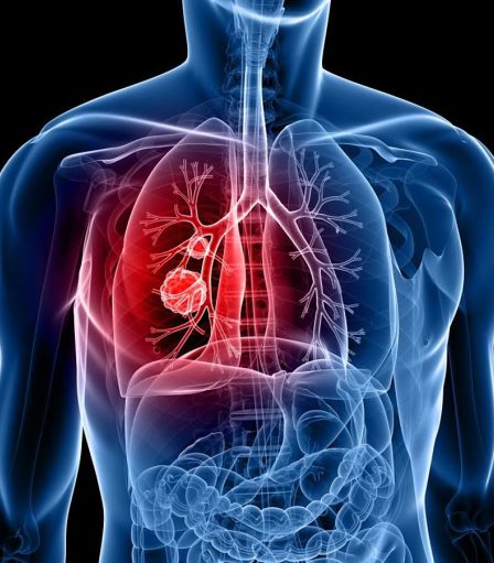 Khối u ung thư phát triển trong phổi. Ảnh: Medical News Today