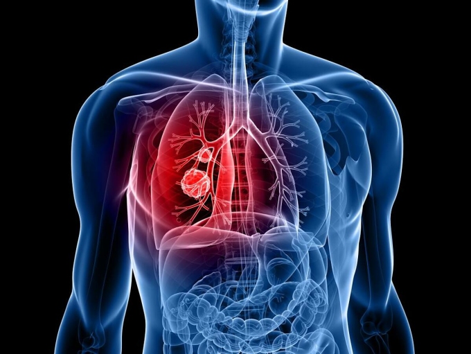Khối u ung thư phát triển trong phổi. Ảnh: Medical News Today